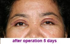 plastic-surgery-blepharoplasty